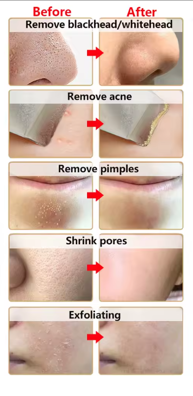 Ultrasonic Skin Cleaner – Blackheads and Dead Skin Remover